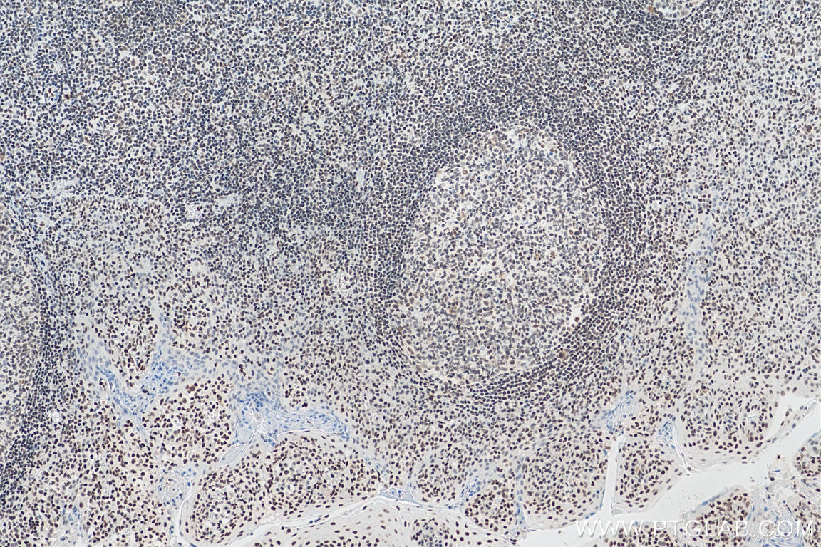 Immunohistochemistry (IHC) staining of human tonsillitis tissue using IFI16 Monoclonal antibody (67790-1-Ig)