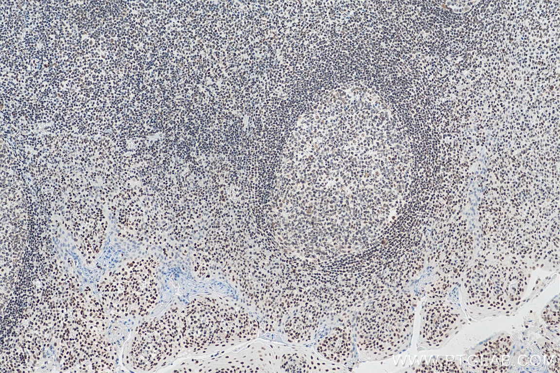 IHC staining of human tonsillitis using 67790-1-Ig