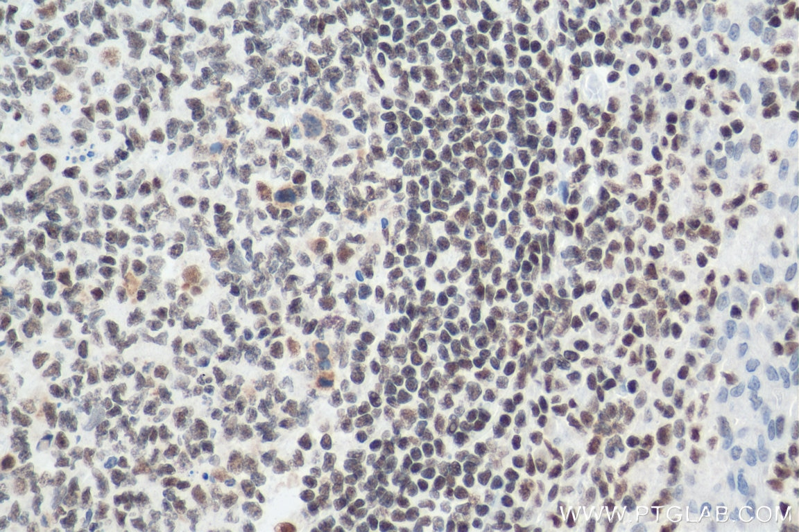 Immunohistochemistry (IHC) staining of human tonsillitis tissue using IFI16 Monoclonal antibody (67790-1-Ig)