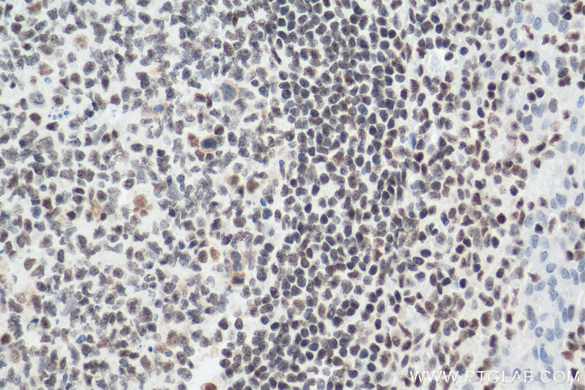 Immunohistochemistry (IHC) staining of human tonsillitis tissue using IFI16 Monoclonal antibody (67790-1-Ig)