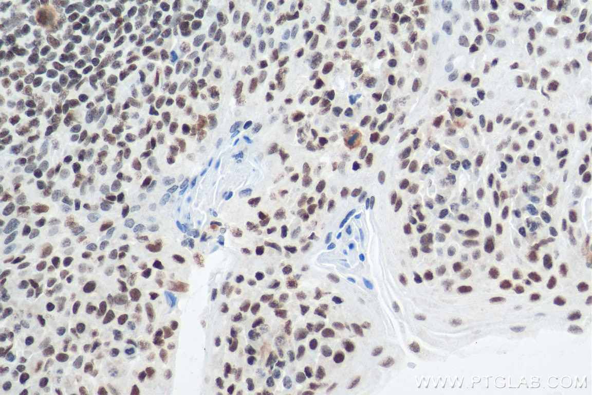 IHC staining of human tonsillitis using 67790-1-Ig