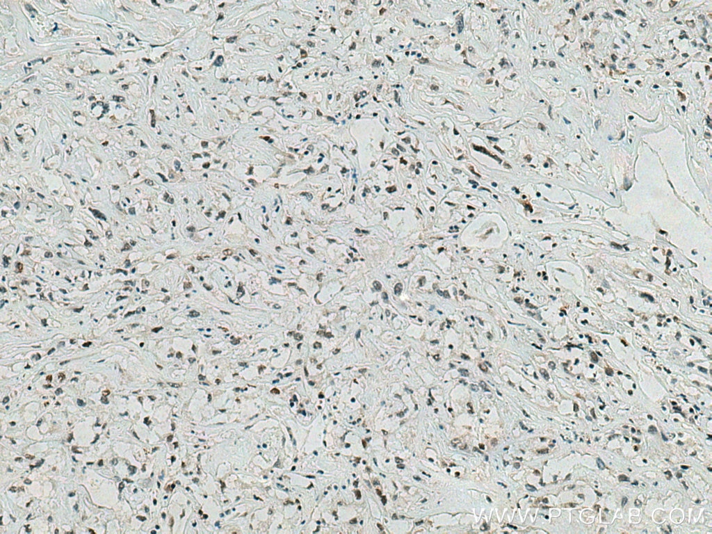 Immunohistochemistry (IHC) staining of human renal cell carcinoma tissue using IFI16 Monoclonal antibody (67790-1-Ig)