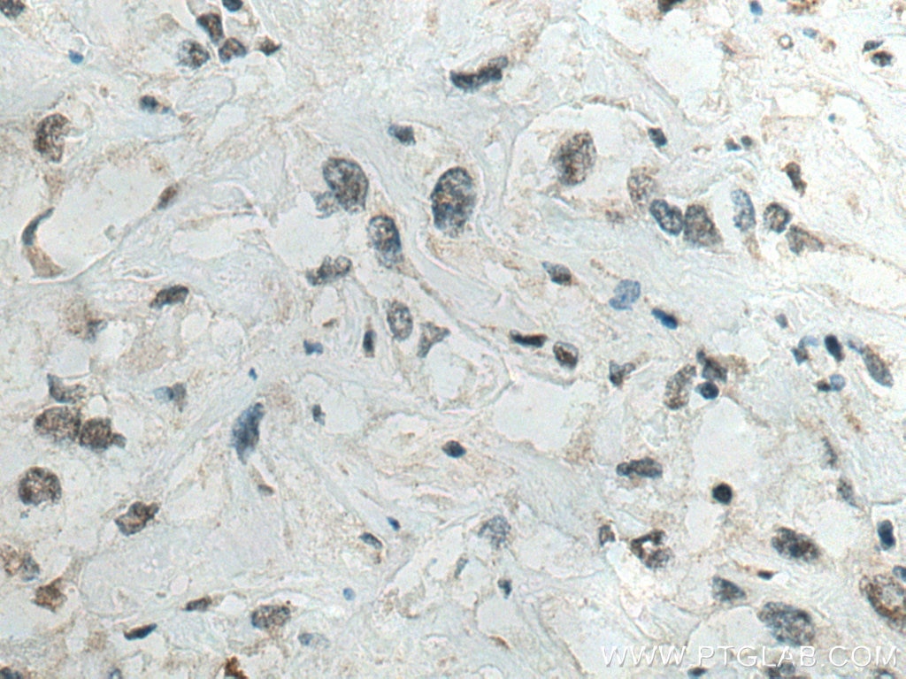 Immunohistochemistry (IHC) staining of human renal cell carcinoma tissue using IFI16 Monoclonal antibody (67790-1-Ig)