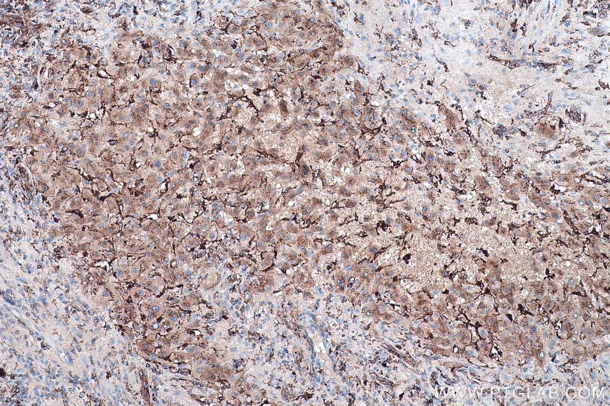 Immunohistochemistry (IHC) staining of human liver cancer tissue using IFI30 Polyclonal antibody (11597-1-AP)
