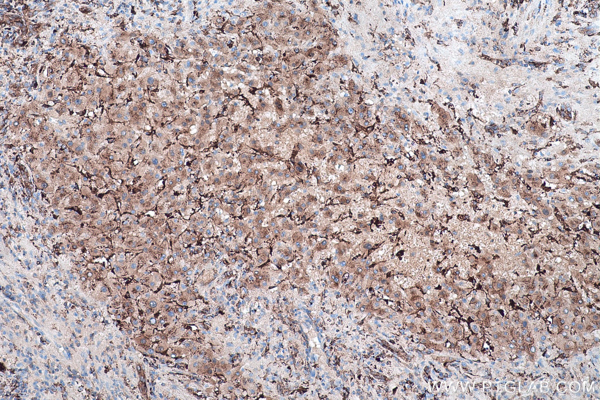 IHC staining of human liver cancer using 11597-1-AP