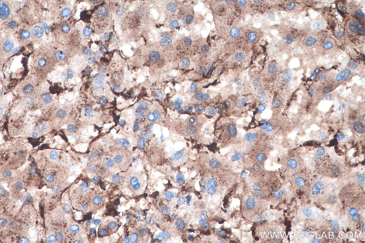 IHC staining of human liver cancer using 11597-1-AP