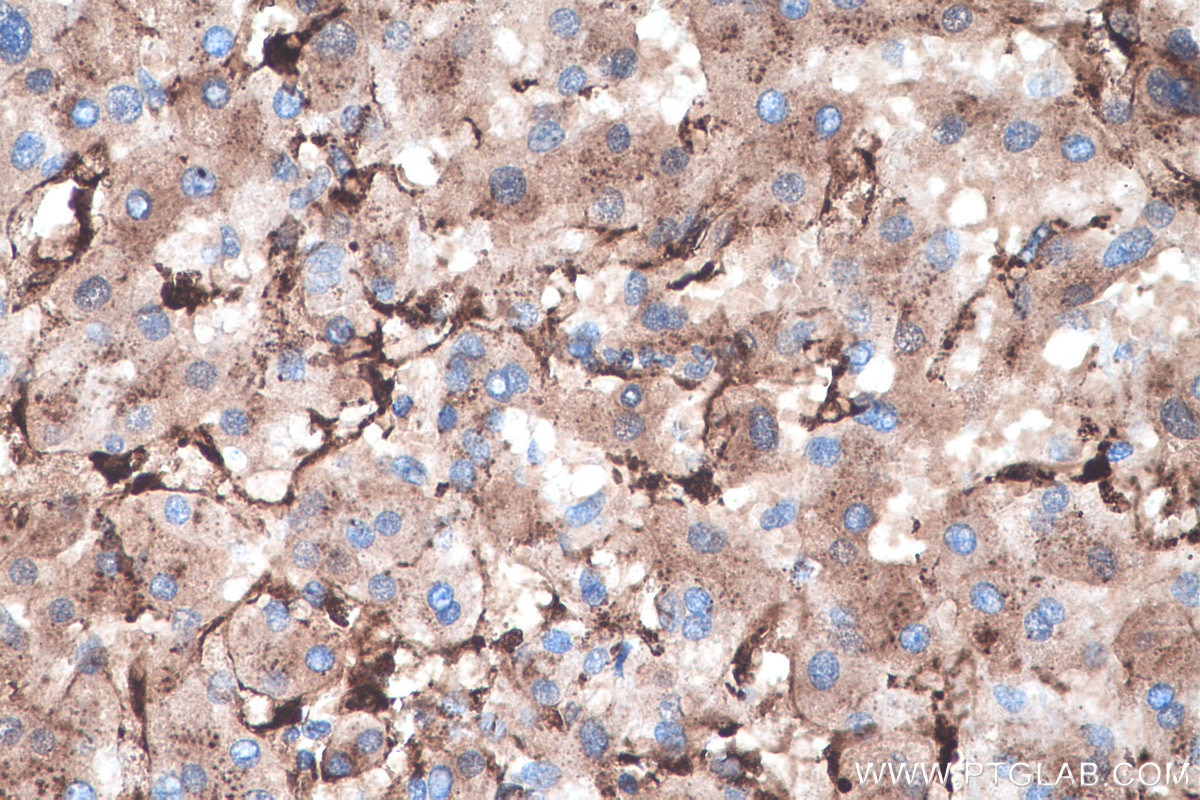 Immunohistochemistry (IHC) staining of human liver cancer tissue using IFI30 Polyclonal antibody (11597-1-AP)