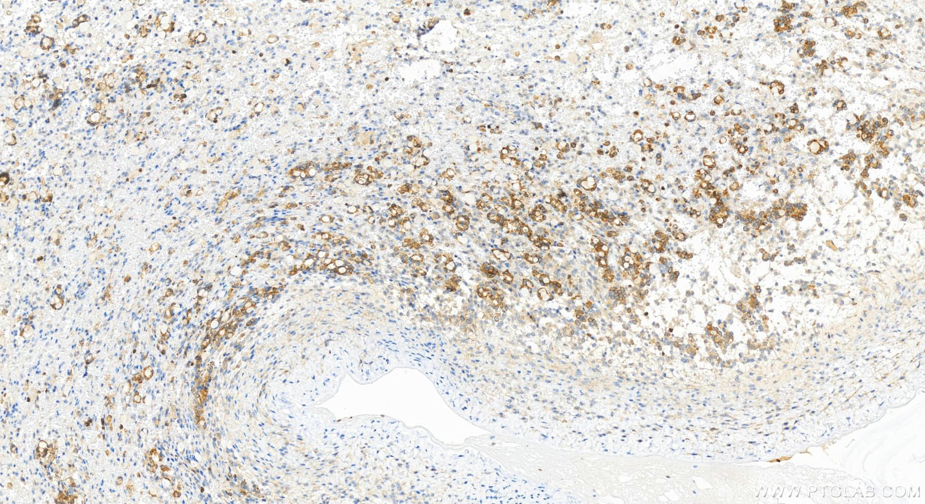Immunohistochemistry (IHC) staining of human ovary cancer tissue using IFI35 Recombinant antibody (83160-4-RR)