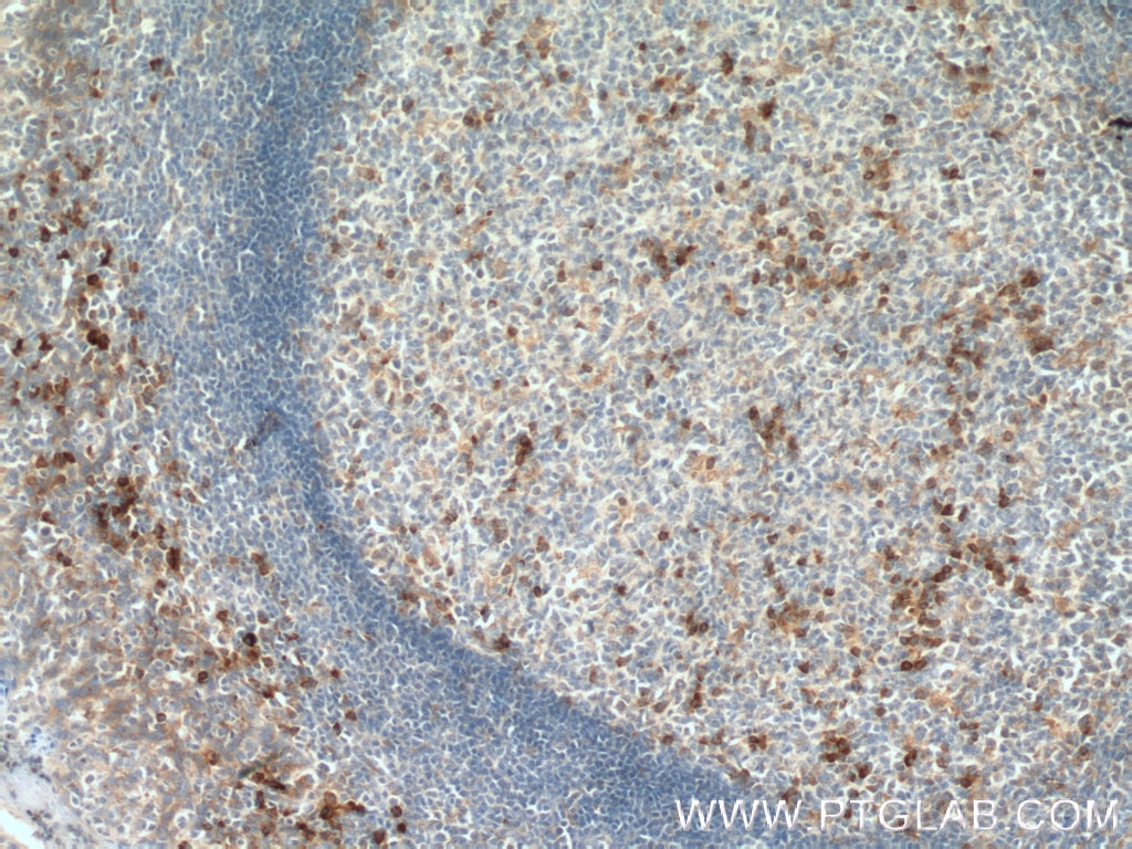 Immunohistochemistry (IHC) staining of human tonsillitis tissue using IFI44 Polyclonal antibody (27233-1-AP)