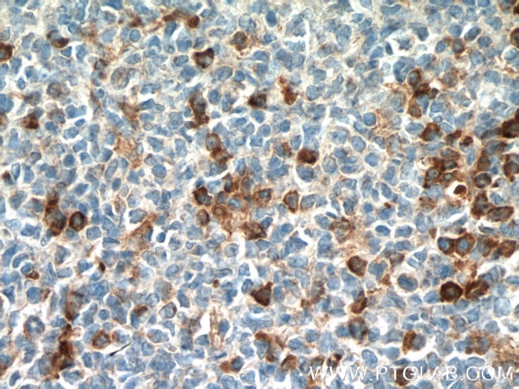 Immunohistochemistry (IHC) staining of human tonsillitis tissue using IFI44 Polyclonal antibody (27233-1-AP)
