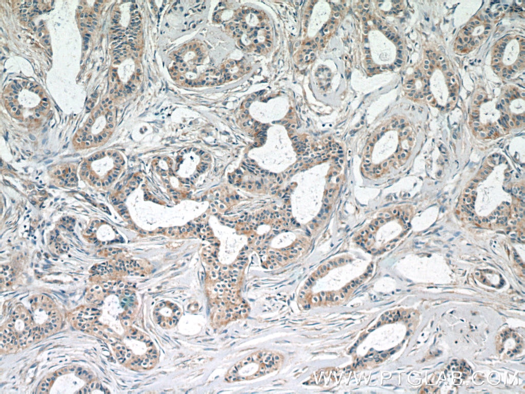 Immunohistochemistry (IHC) staining of human breast cancer tissue using G1P3 Polyclonal antibody (11246-1-AP)