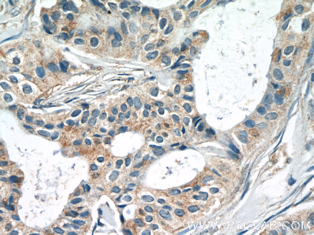 Immunohistochemistry (IHC) staining of human breast cancer tissue using G1P3 Polyclonal antibody (11246-1-AP)