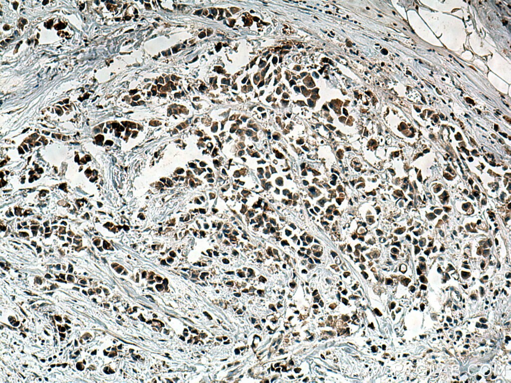 Immunohistochemistry (IHC) staining of human breast cancer tissue using G1P3 Polyclonal antibody (11246-1-AP)