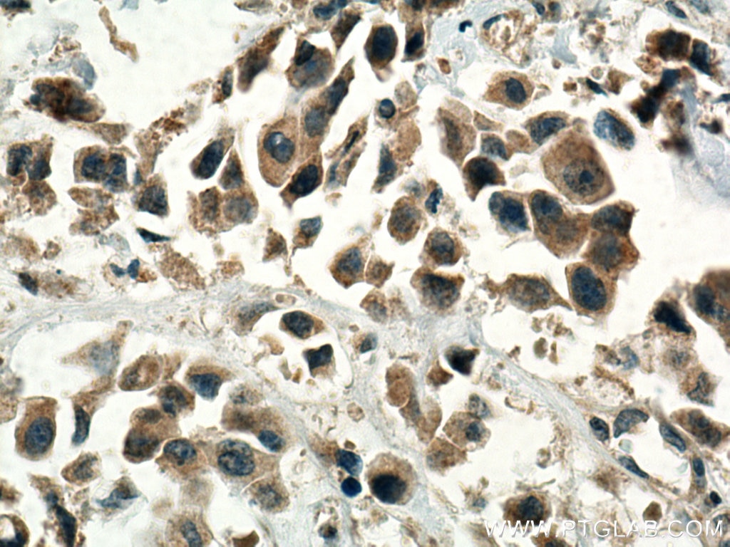 Immunohistochemistry (IHC) staining of human breast cancer tissue using G1P3 Polyclonal antibody (11246-1-AP)