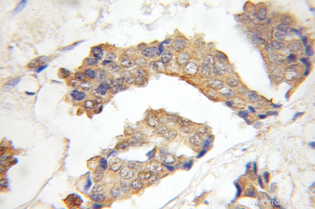 Immunohistochemistry (IHC) staining of human breast cancer tissue using G1P3 Polyclonal antibody (11246-1-AP)