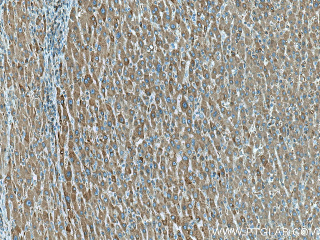 Immunohistochemistry (IHC) staining of human liver cancer tissue using IFIH1/MDA5 Monoclonal antibody (66770-1-Ig)