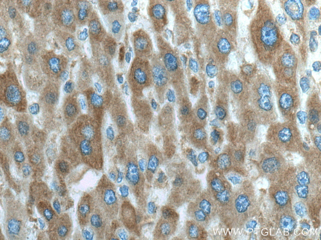 Immunohistochemistry (IHC) staining of human liver cancer tissue using IFIH1/MDA5 Monoclonal antibody (66770-1-Ig)