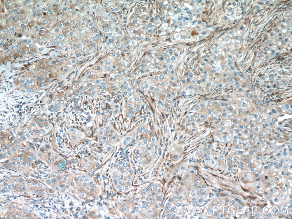 Immunohistochemistry (IHC) staining of human breast cancer tissue using IFIT1 Polyclonal antibody (23247-1-AP)