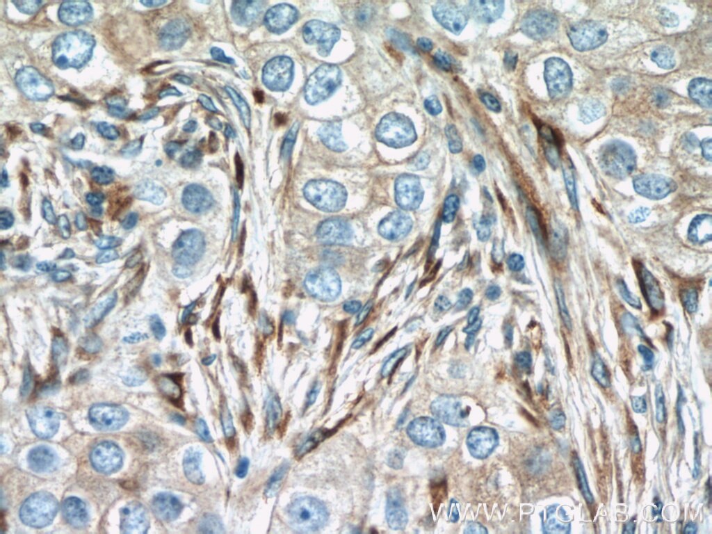 Immunohistochemistry (IHC) staining of human breast cancer tissue using IFIT1 Polyclonal antibody (23247-1-AP)