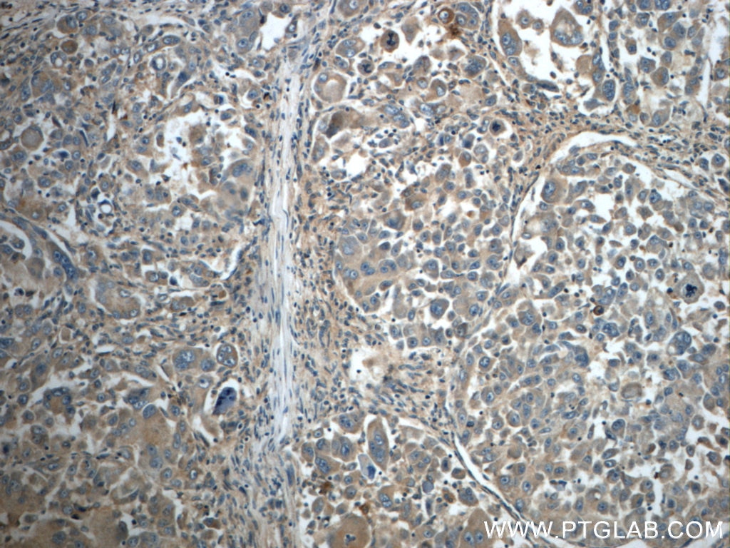 Immunohistochemistry (IHC) staining of human liver cancer tissue using IFIT1 Polyclonal antibody (23247-1-AP)