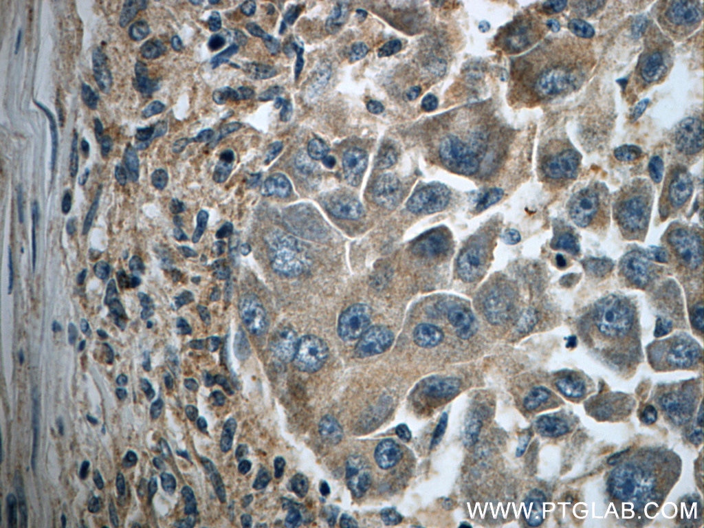 Immunohistochemistry (IHC) staining of human liver cancer tissue using IFIT1 Polyclonal antibody (23247-1-AP)