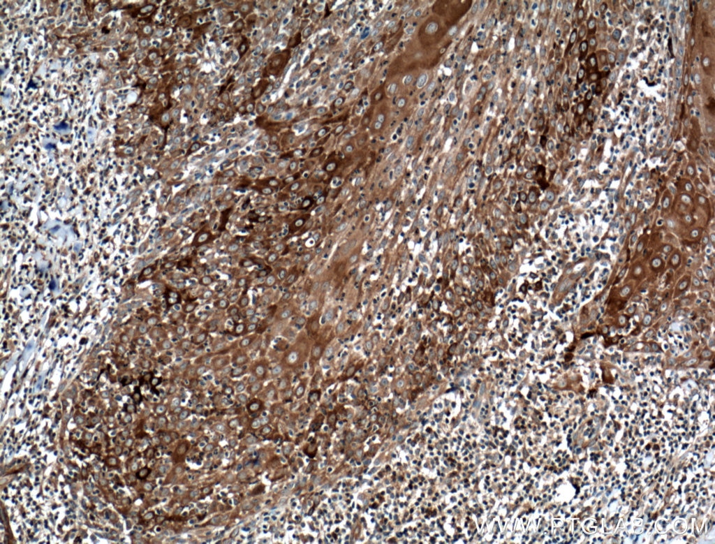 Immunohistochemistry (IHC) staining of human skin cancer tissue using IFIT2 Polyclonal antibody (12604-1-AP)