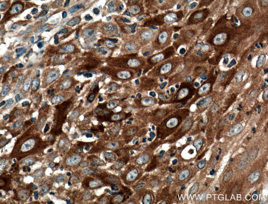 Immunohistochemistry (IHC) staining of human skin cancer tissue using IFIT2 Polyclonal antibody (12604-1-AP)