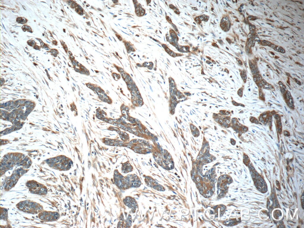 Immunohistochemistry (IHC) staining of human skin cancer tissue using IFIT5 Polyclonal antibody (13378-1-AP)