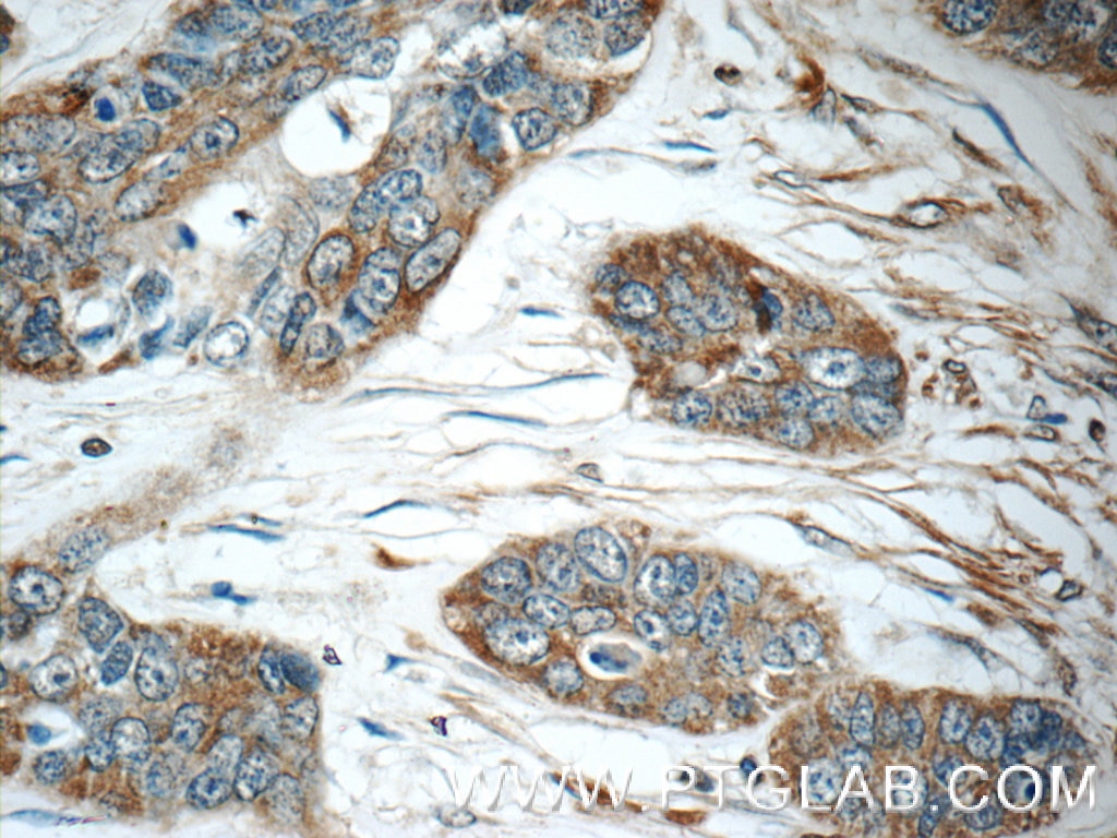 Immunohistochemistry (IHC) staining of human skin cancer tissue using IFIT5 Polyclonal antibody (13378-1-AP)