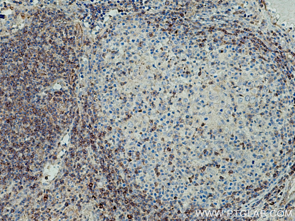 Immunohistochemistry (IHC) staining of human lymphoma tissue using IFITM1 Polyclonal antibody (11727-3-AP)