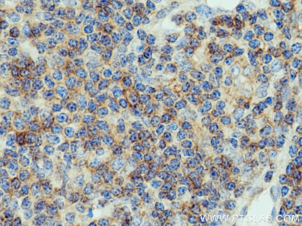 IHC staining of human lymphoma using 11727-3-AP