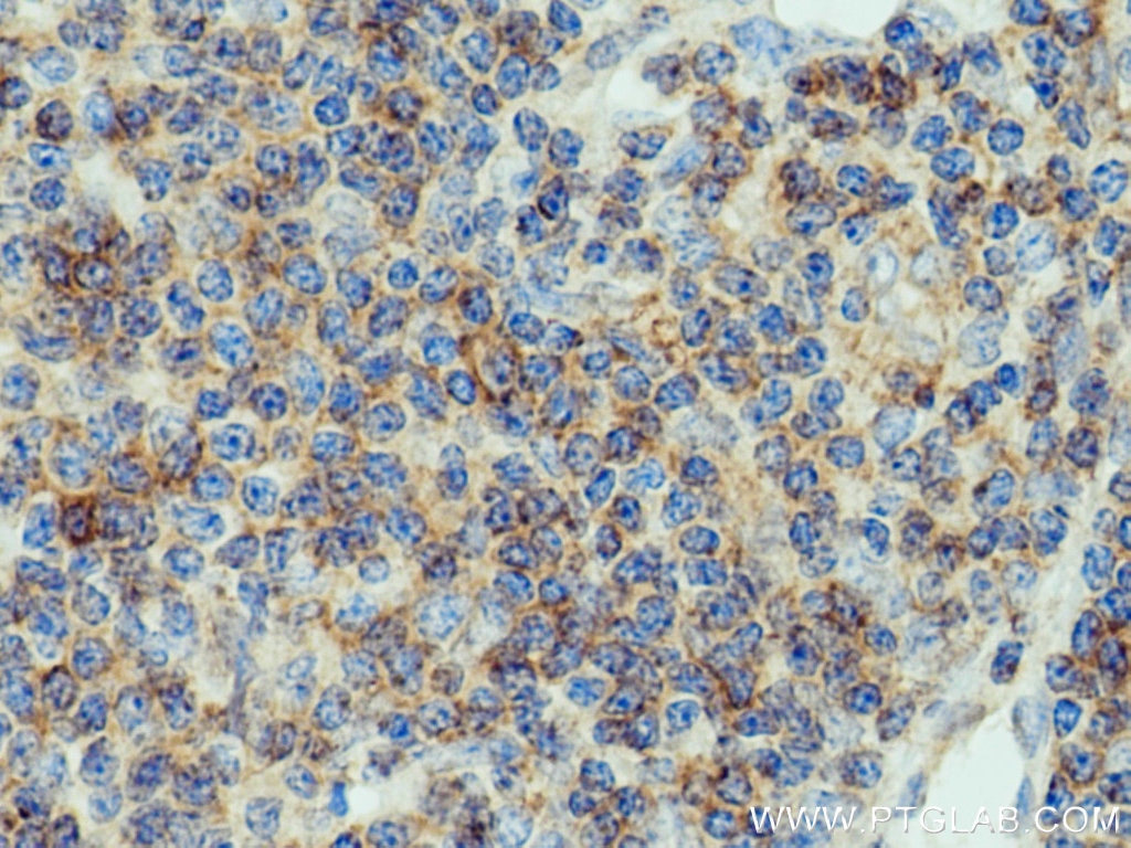 Immunohistochemistry (IHC) staining of human lymphoma tissue using IFITM1 Polyclonal antibody (11727-3-AP)