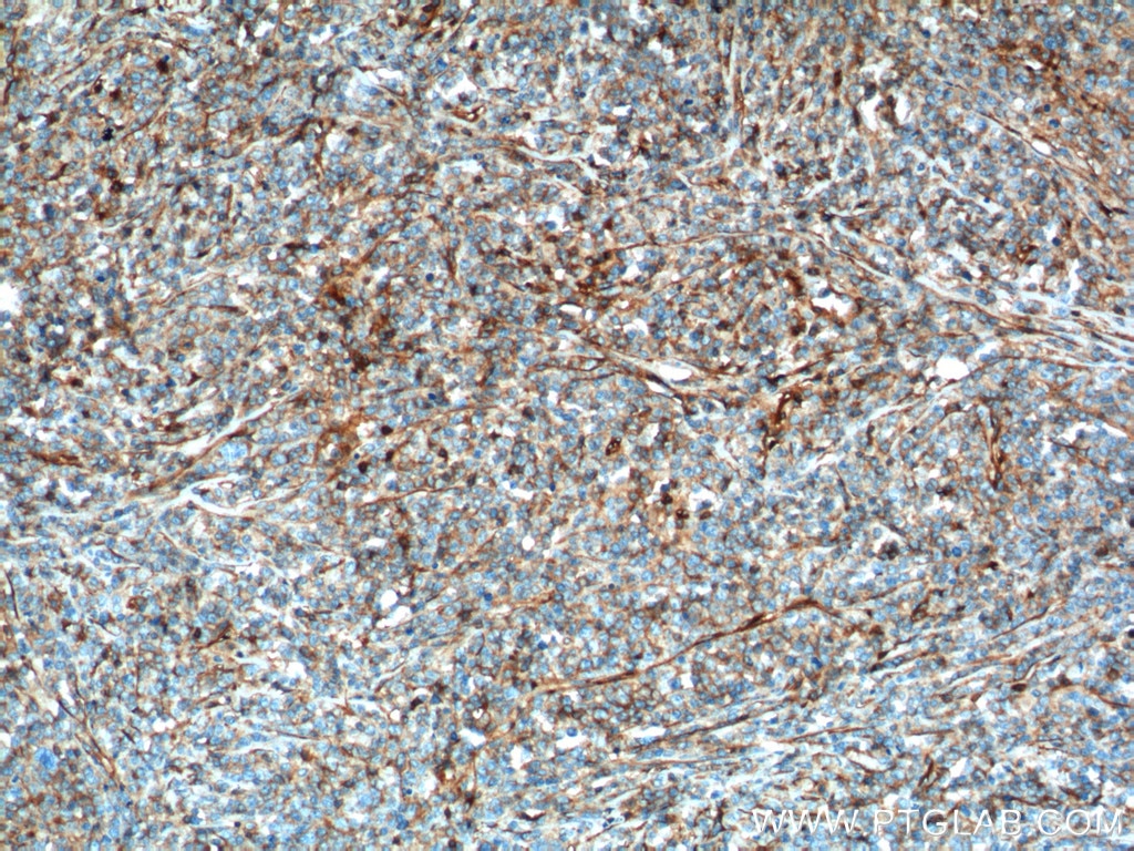 Immunohistochemistry (IHC) staining of human lymphoma tissue using IFITM1-Specific Monoclonal antibody (60074-1-Ig)