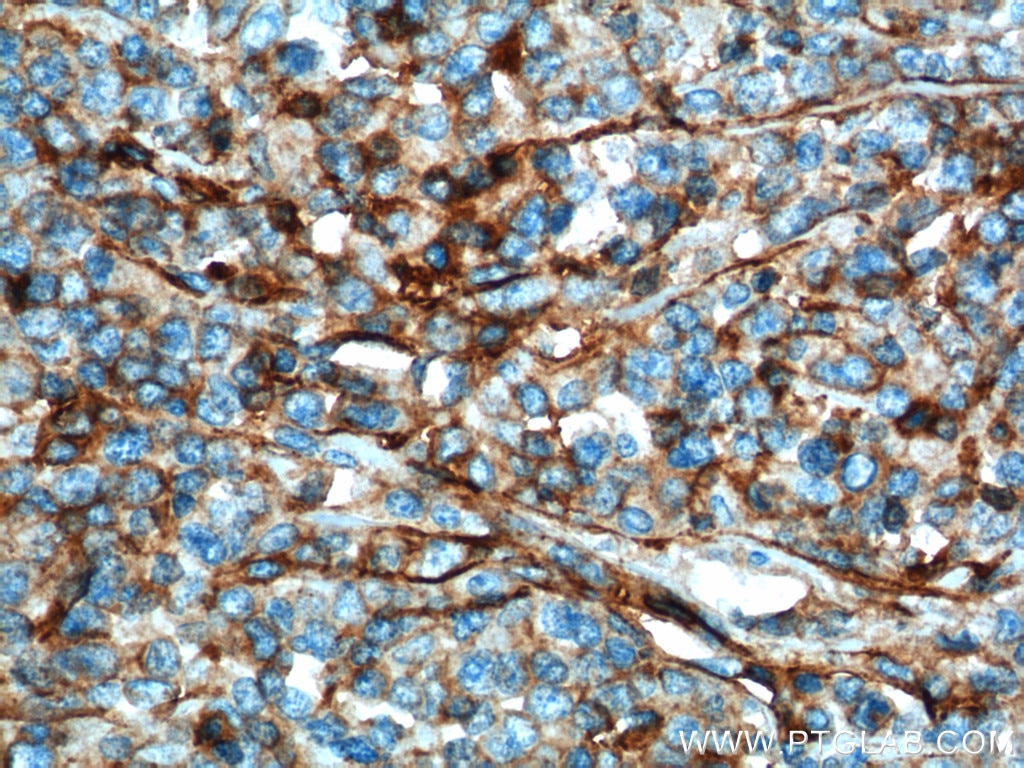 Immunohistochemistry (IHC) staining of human lymphoma tissue using IFITM1-Specific Monoclonal antibody (60074-1-Ig)