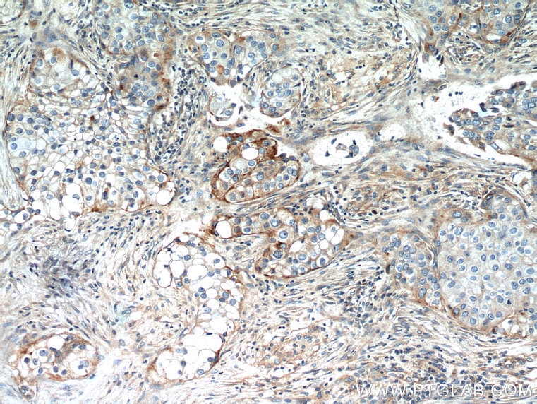 Immunohistochemistry (IHC) staining of human breast cancer tissue using IFITM2 Polyclonal antibody (12769-1-AP)