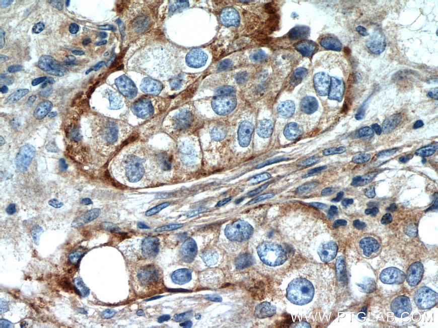 Immunohistochemistry (IHC) staining of human breast cancer tissue using IFITM2 Polyclonal antibody (12769-1-AP)