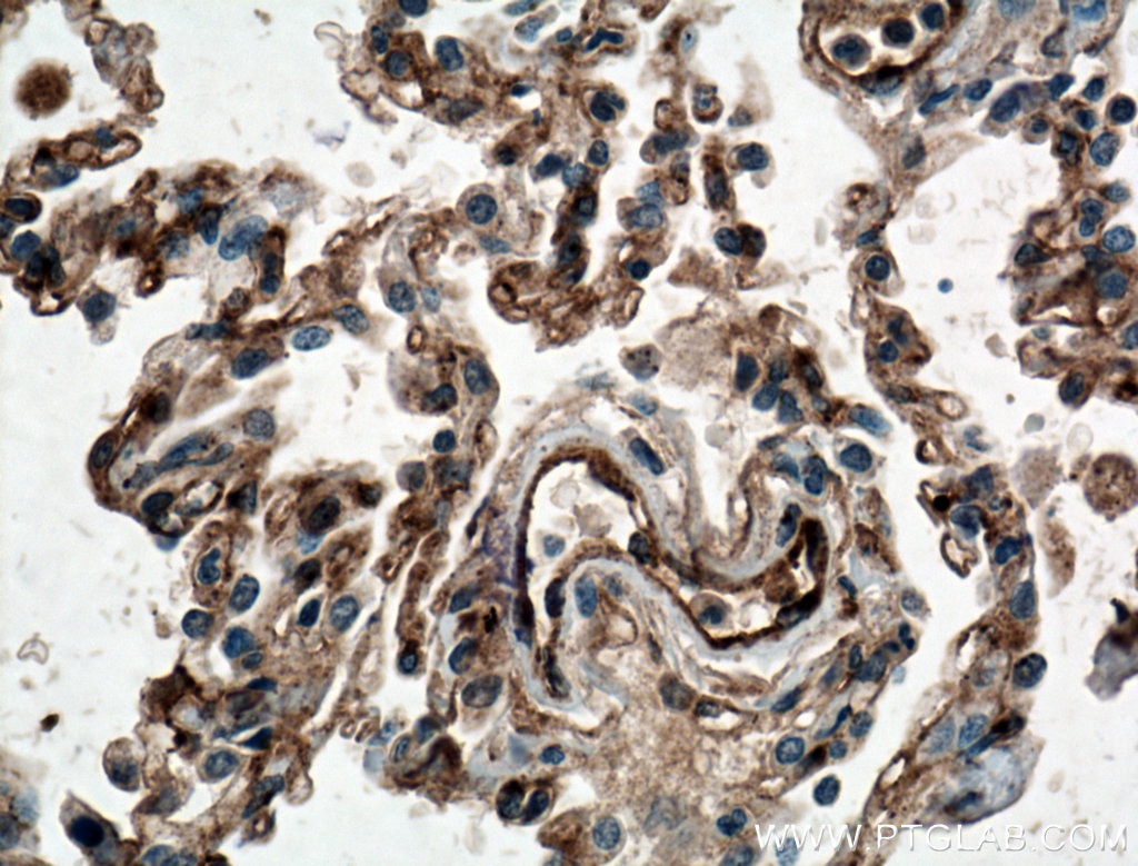 IHC staining of human lung cancer using 11714-1-AP