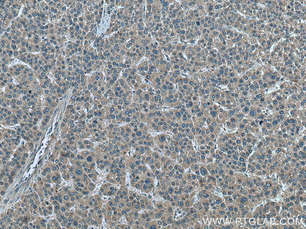 IHC staining of human liver cancer using 66081-1-Ig