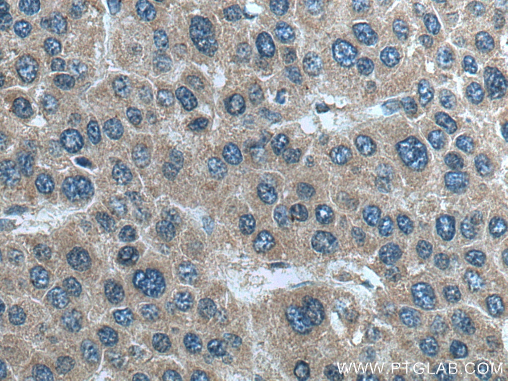 IHC staining of human liver cancer using 66081-1-Ig