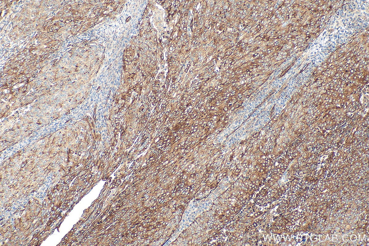 IHC staining of human ovary tumor using RMX00071 Immunohistochemistry (IHC) staining of human ovary tumor tissue using Multi-rAb® IFITM3 Multi-Recombinant antibody (RMX00071)