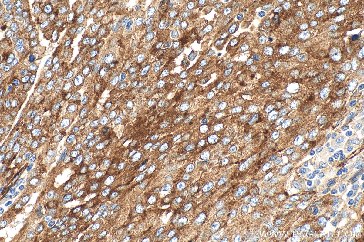 IHC staining of human ovary tumor using RMX00071 Immunohistochemistry (IHC) staining of human ovary tumor tissue using Multi-rAb® IFITM3 Multi-Recombinant antibody (RMX00071)