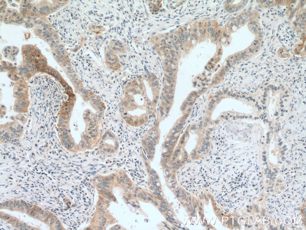 Immunohistochemistry (IHC) staining of human pancreas cancer tissue using IFNGR1 Polyclonal antibody (10808-1-AP)