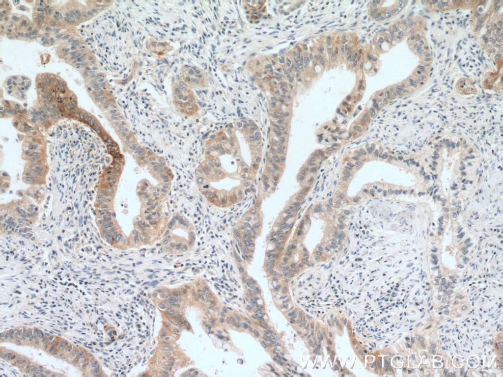 IHC staining of human pancreas cancer using 10808-1-AP