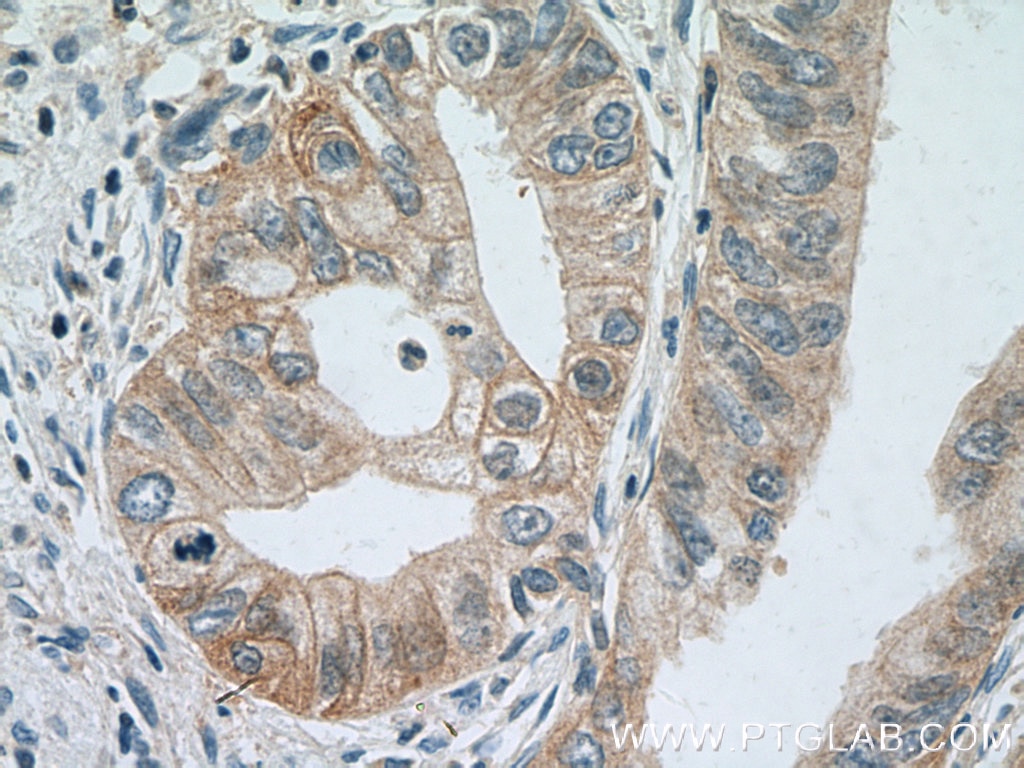 Immunohistochemistry (IHC) staining of human pancreas cancer tissue using IFNGR1 Polyclonal antibody (10808-1-AP)