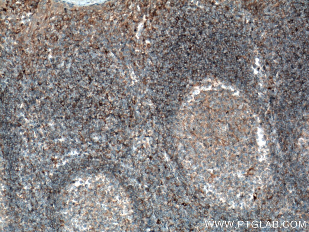 IHC staining of human tonsillitis using 66704-1-Ig