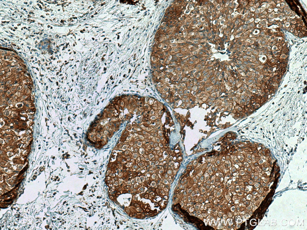 Immunohistochemistry (IHC) staining of human breast cancer tissue using IFNGR2 Polyclonal antibody (10266-1-AP)