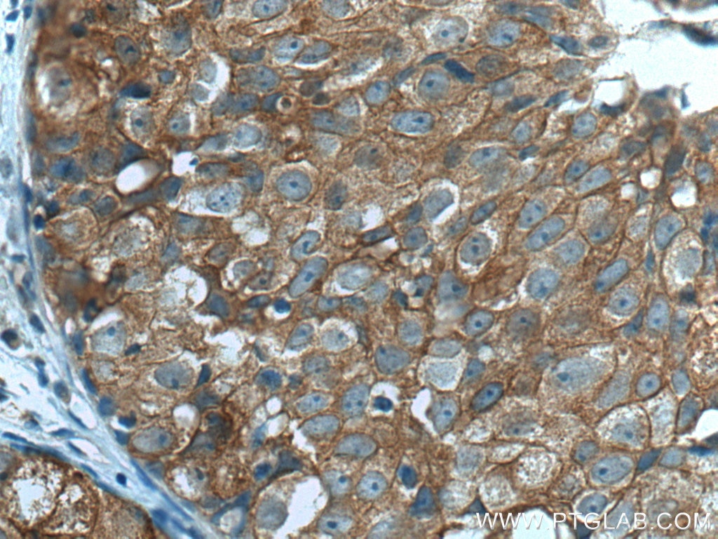 Immunohistochemistry (IHC) staining of human breast cancer tissue using IFNGR2 Polyclonal antibody (10266-1-AP)