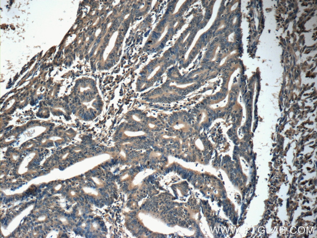 IHC staining of human endometrial cancer using 13615-1-AP