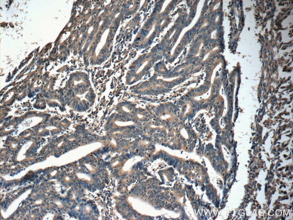 Immunohistochemistry (IHC) staining of human endometrial cancer tissue using IFT20 Polyclonal antibody (13615-1-AP)