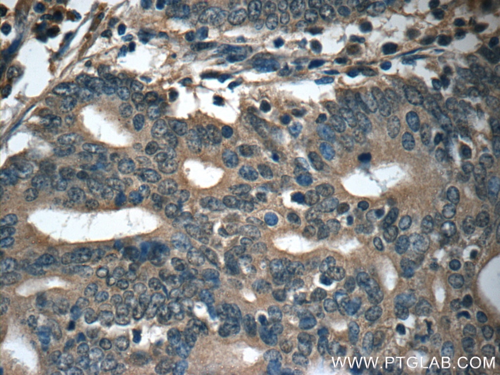 Immunohistochemistry (IHC) staining of human endometrial cancer tissue using IFT20 Polyclonal antibody (13615-1-AP)